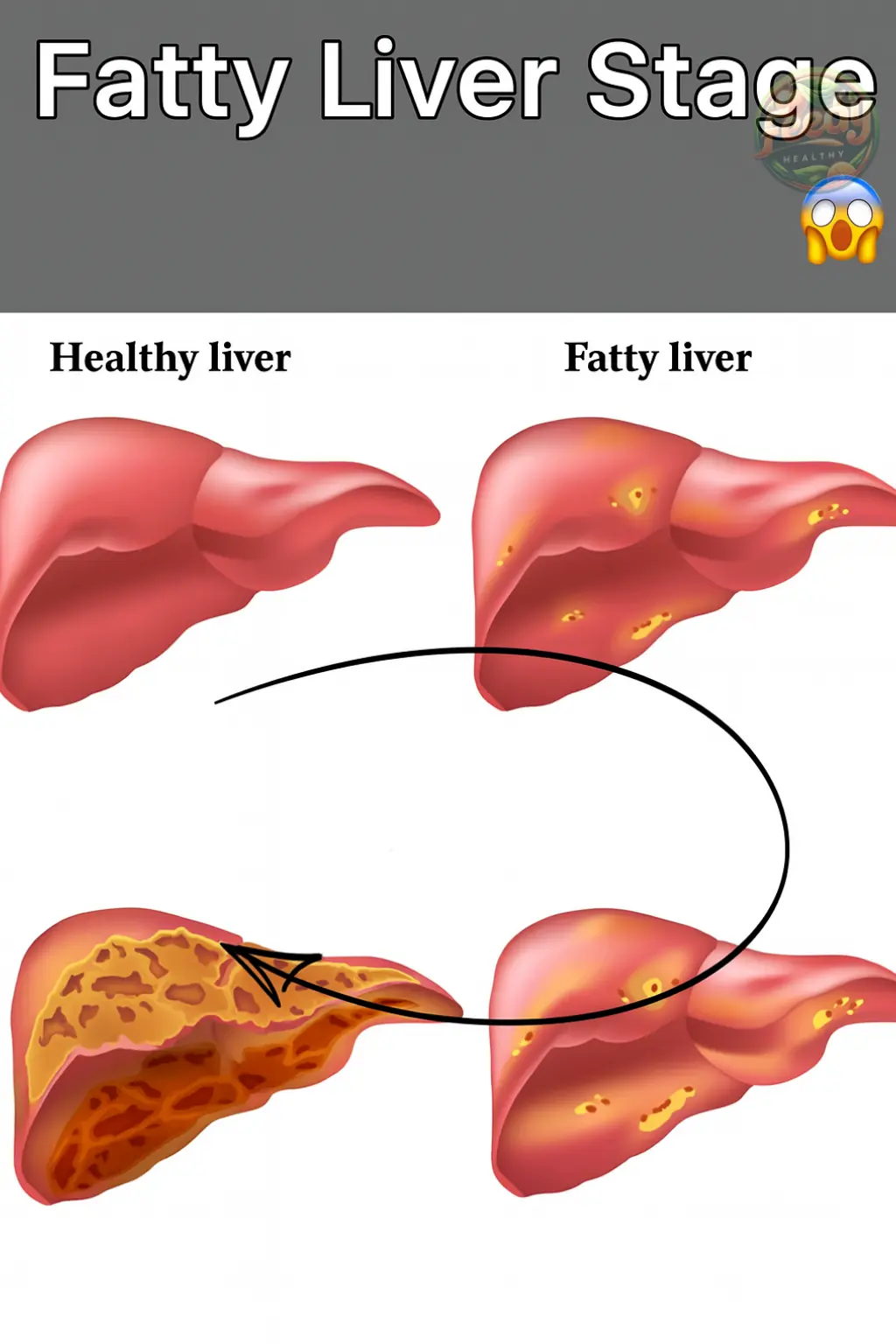 Take Care of Your Fatty Liver β Learn How to Cleanse Your Liver