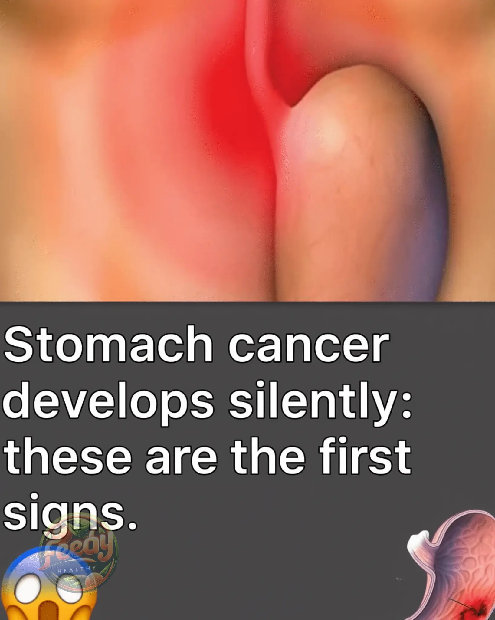 Stomach Cancer: Silent but Dangerous β Know the Early Signs