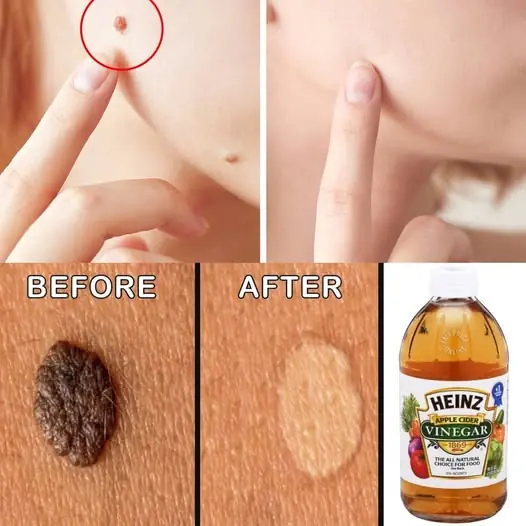 Natural Ways to Remove Skin Moles at Home 🌿