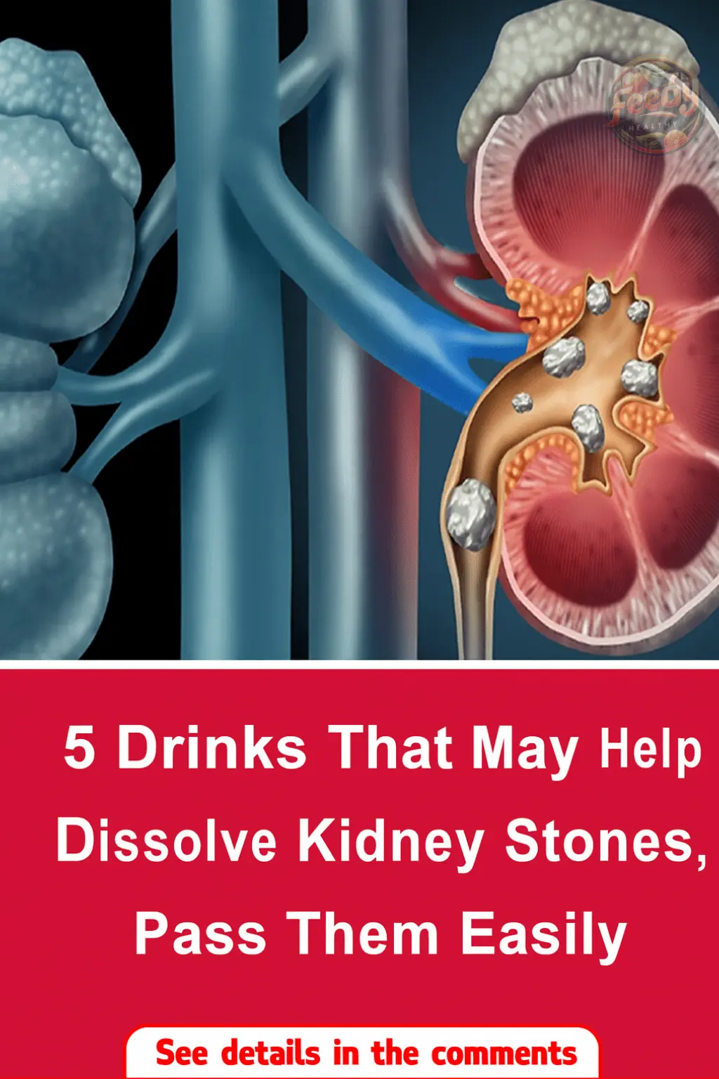 5 Drinks That May Help Dissolve Kidney Stones and Make Passing Them Easier