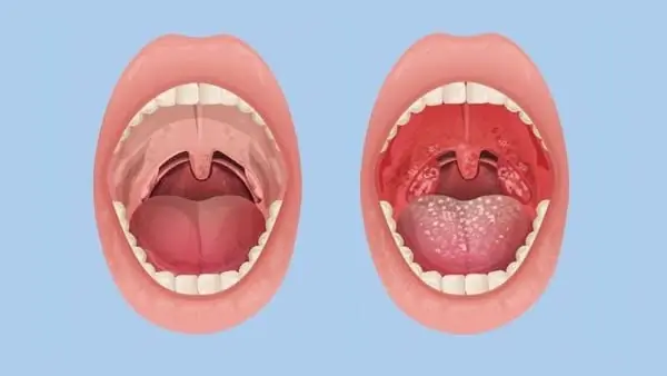 Many people mistake nasopharyngeal cancer for tonsillitis: Doctor explains how to tell them apart through associated symptoms