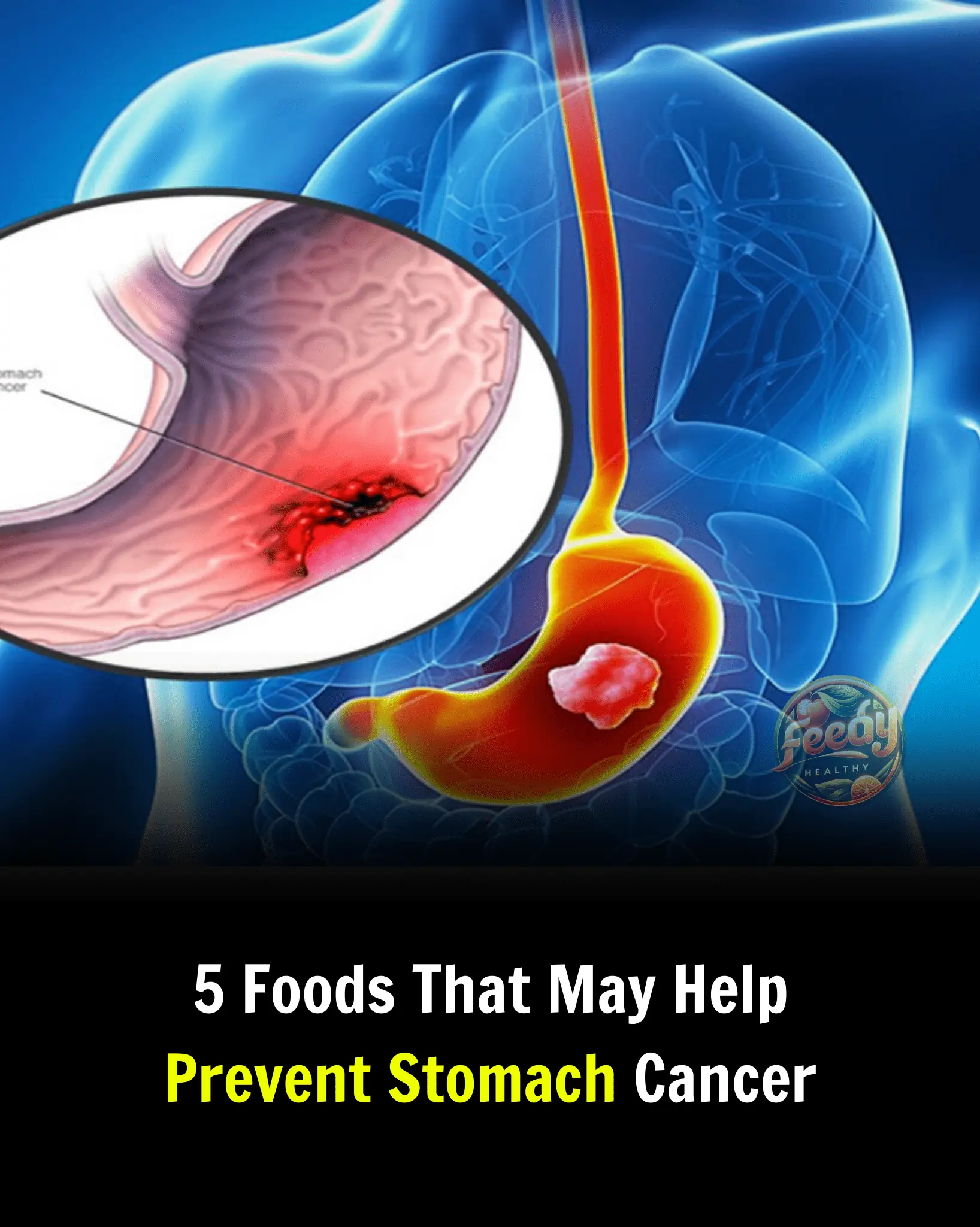 5 Foods That May Help Prevent Stomach Cancer