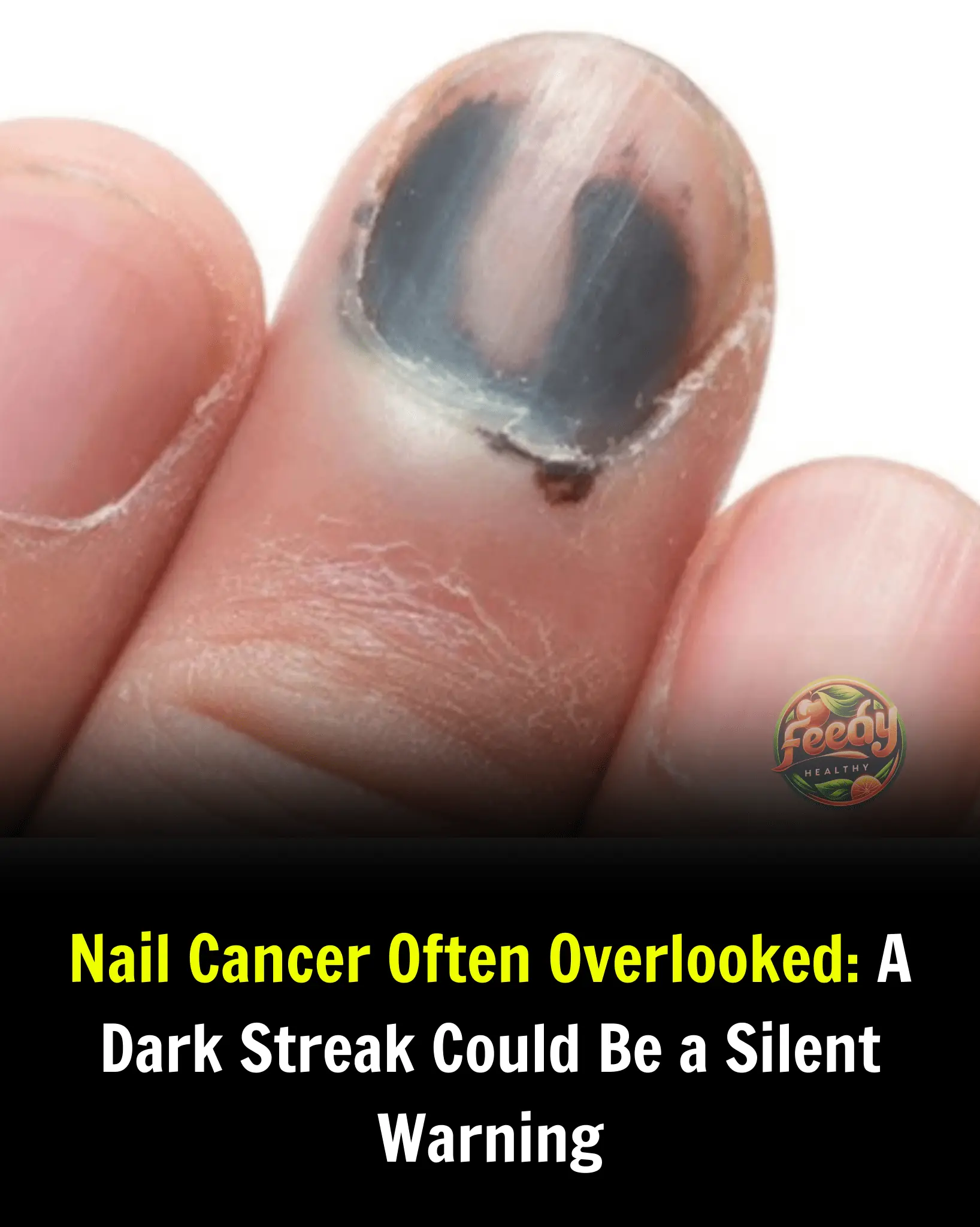 Nail Cancer Often Overlooked: A Dark Streak Could Be a Silent Warning