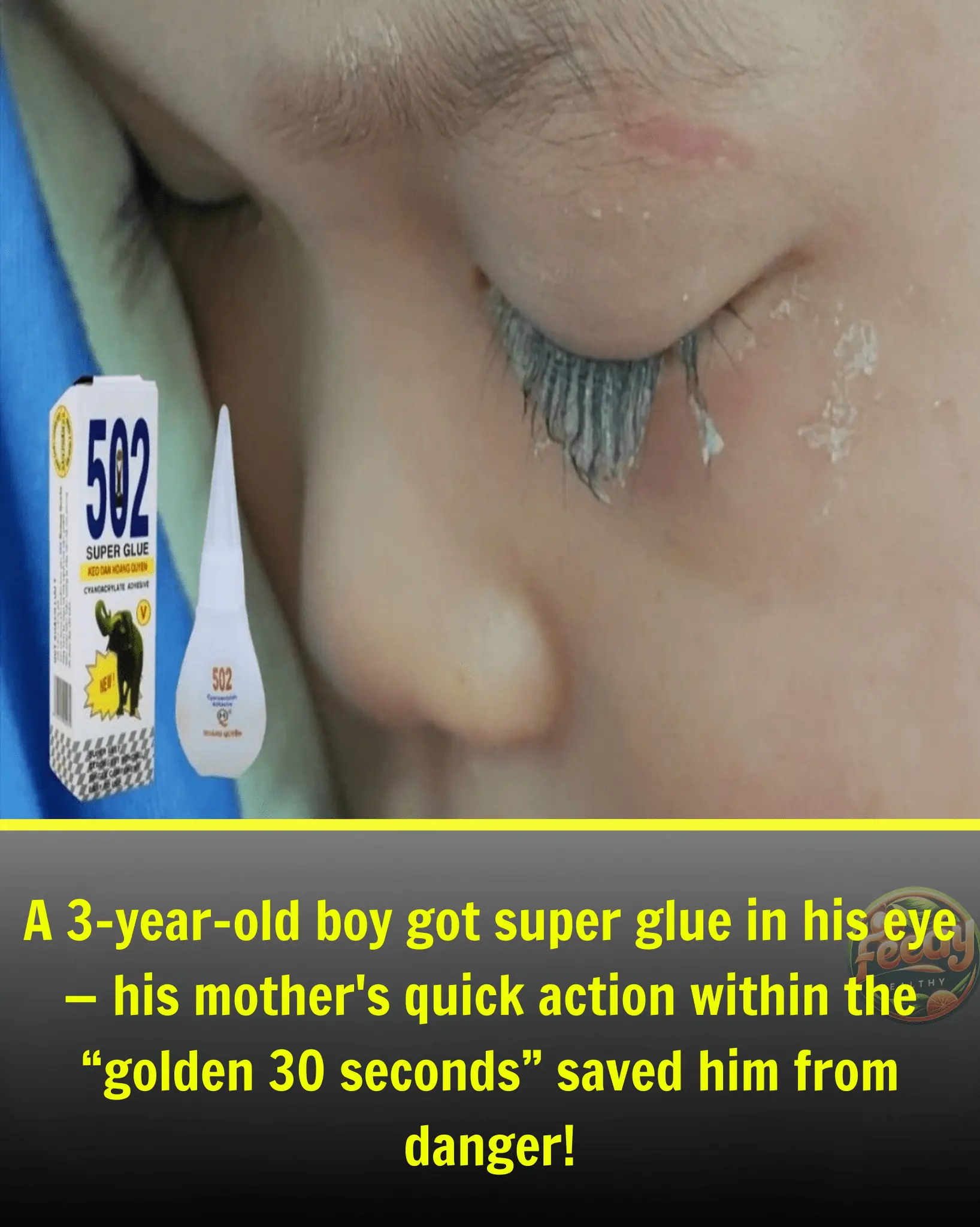 3-Year-Old Boy Gets Super Glue in His Eye: Mother's “Golden 30 Seconds” Action Saves Him from Blindness