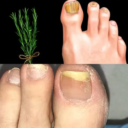 Say Goodbye to Nail Fungus with Rosemary – A Natural Remedy