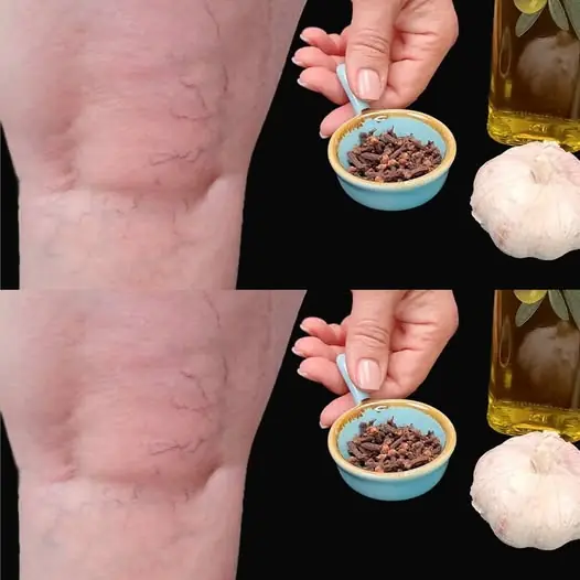 Natural Remedy for Leg Pain, Rheumatism, Varicose Veins, and Arthritis with Cloves & Garlic 🧄🌿