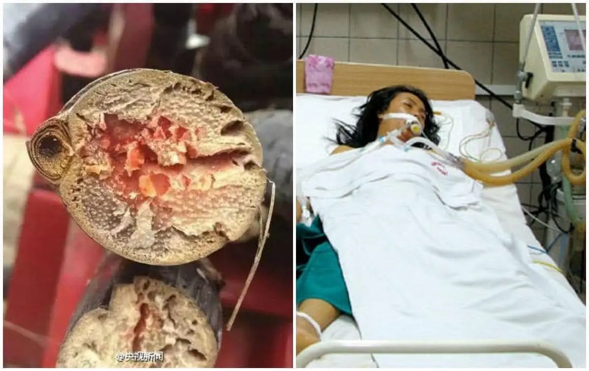 If You Have Colon Polyps, These 4 Symptoms During Bowel Movements Could Be a Warning – See a Doctor Before It's Too Late
