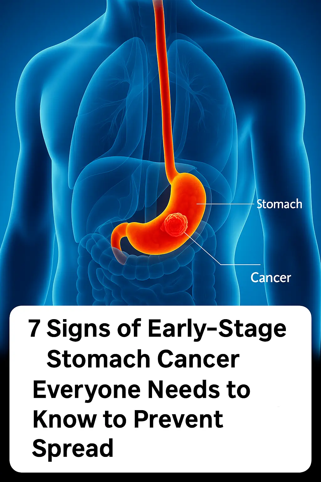 7 Early Signs of Stomach Cancer Everyone Should Know to Prevent Metastasis
