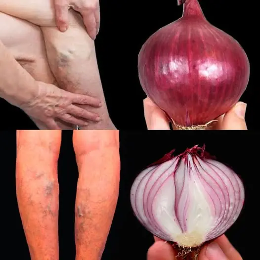 Unbelievable! 🤩 The Varicose Vein Killer – Top 5 Red Onion Remedies That Erase Varicose Veins Like an Eraser! 🧅✨