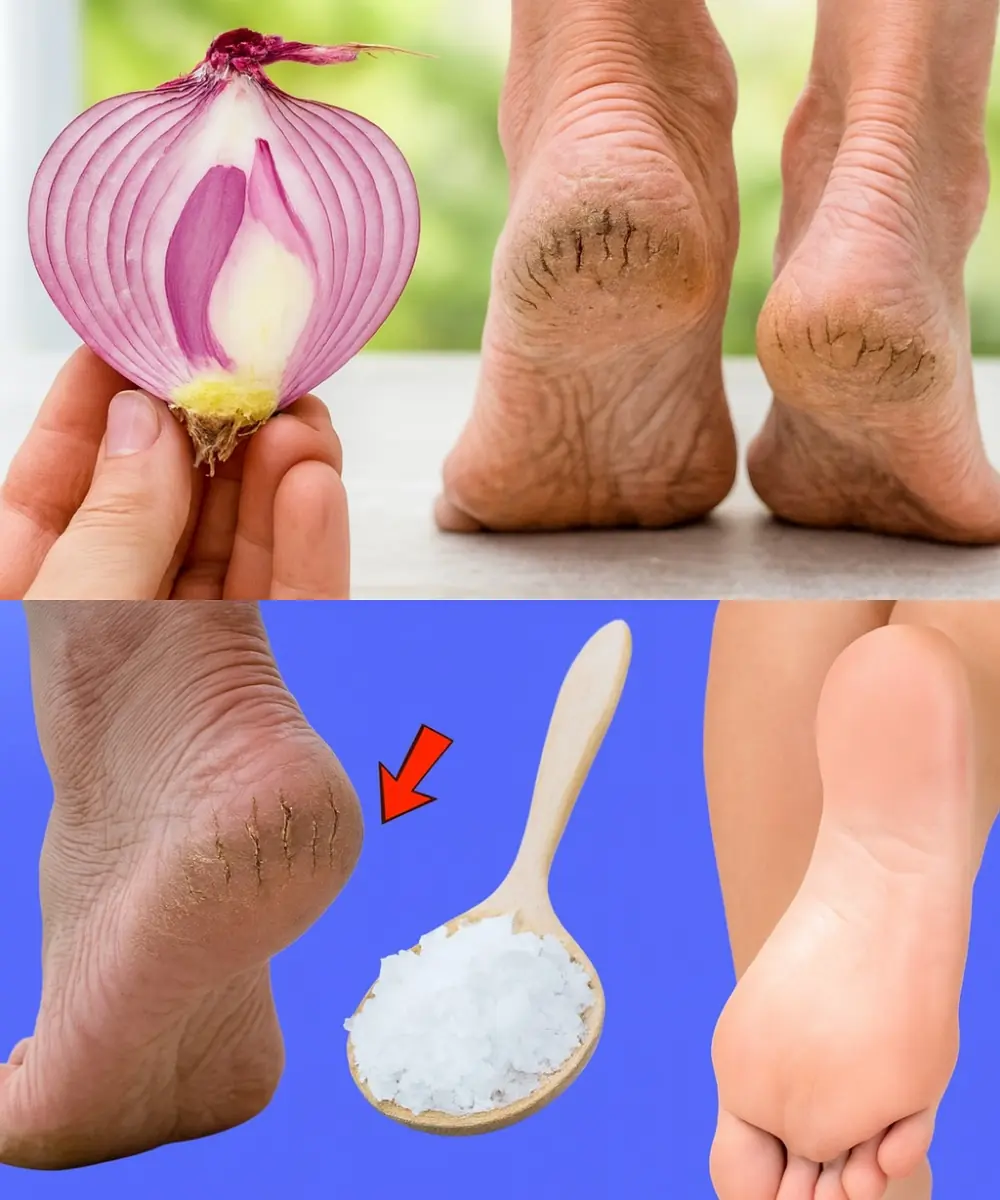 Smooth Feet in Days: 5 Natural Remedies for Cracked Heels That Really Work