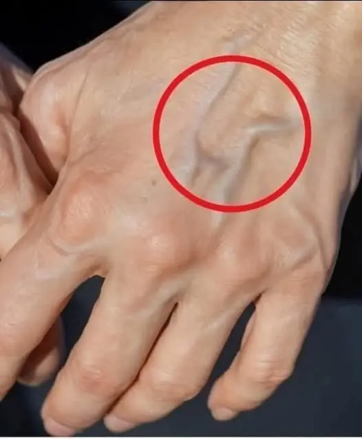 Natural Remedies to Improve the Health of Your Veins and Skin