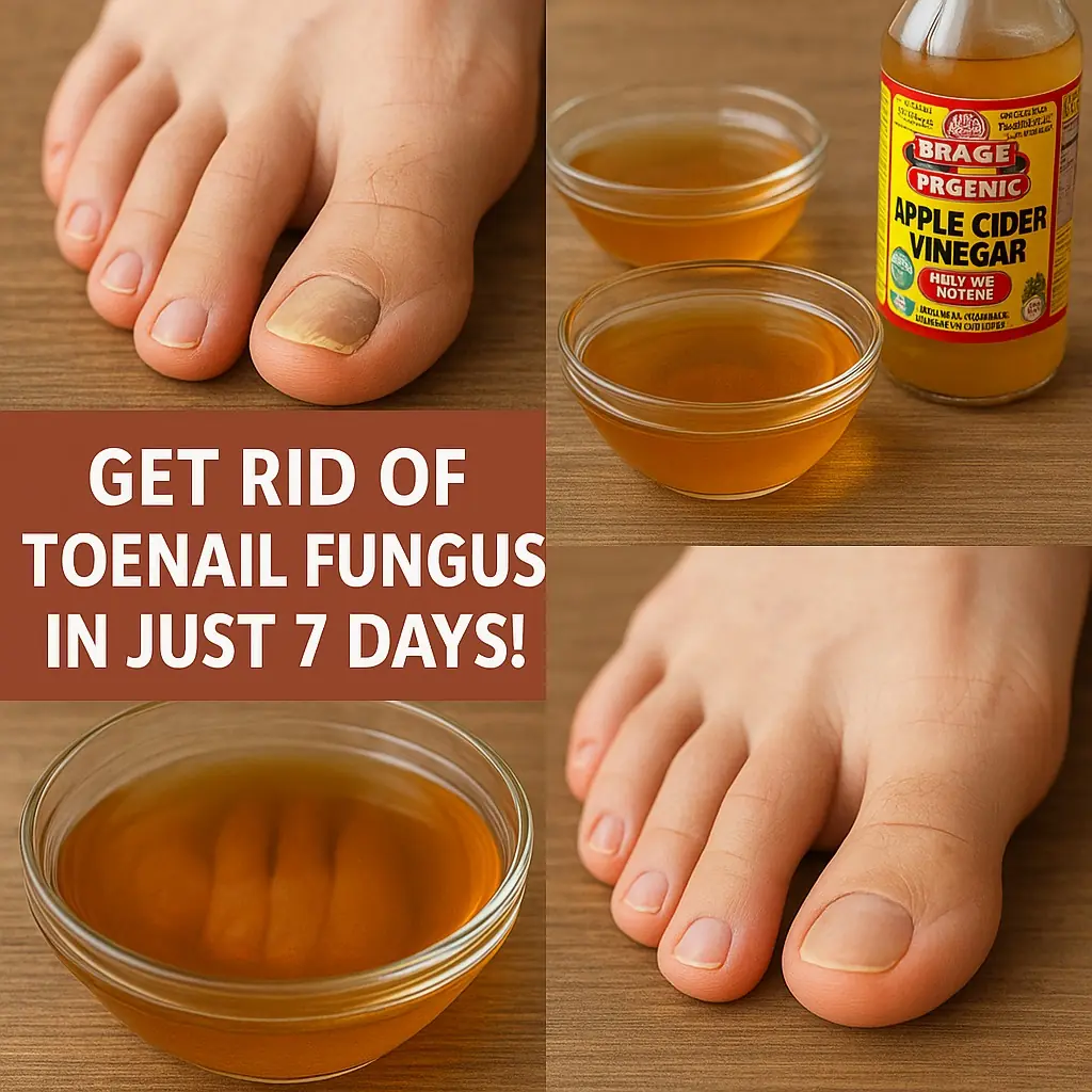 Say Goodbye to Toenail Fungus Naturally in Just 7 Days!