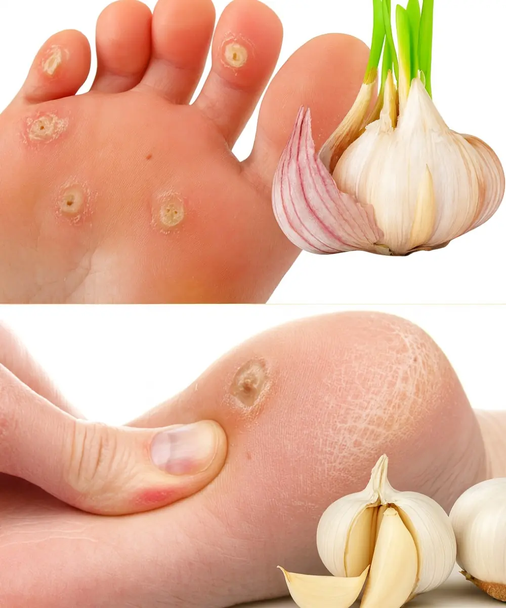 Banish Plantar Warts Naturally: Unlock Garlic’s Healing Power