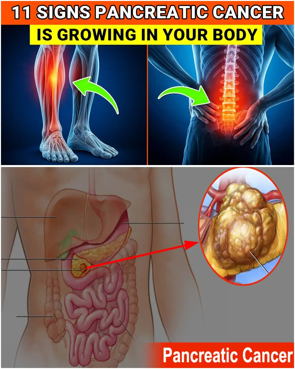 Donโt Miss These 11 Early Signs of Pancreatic Cancer โ This Could Save Your Life