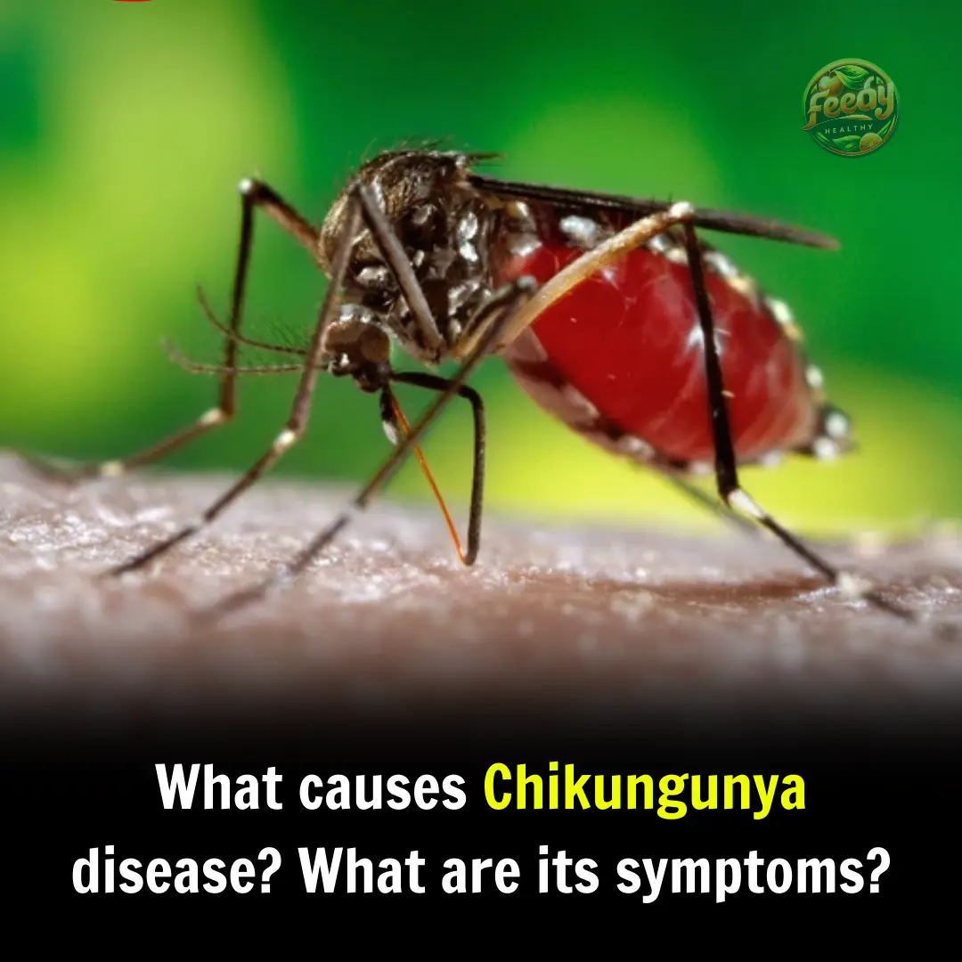 Chikungunya Disease: Causes, Symptoms, Diagnosis, Treatment, and Prevention