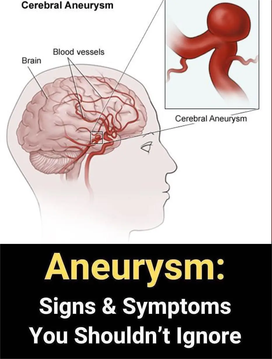 12 signs that may signal a brain aneurysm — Don’t ignore them