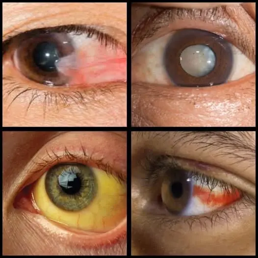 Warning Signs in Your Eyes: When to Seek Urgent Medical Attention