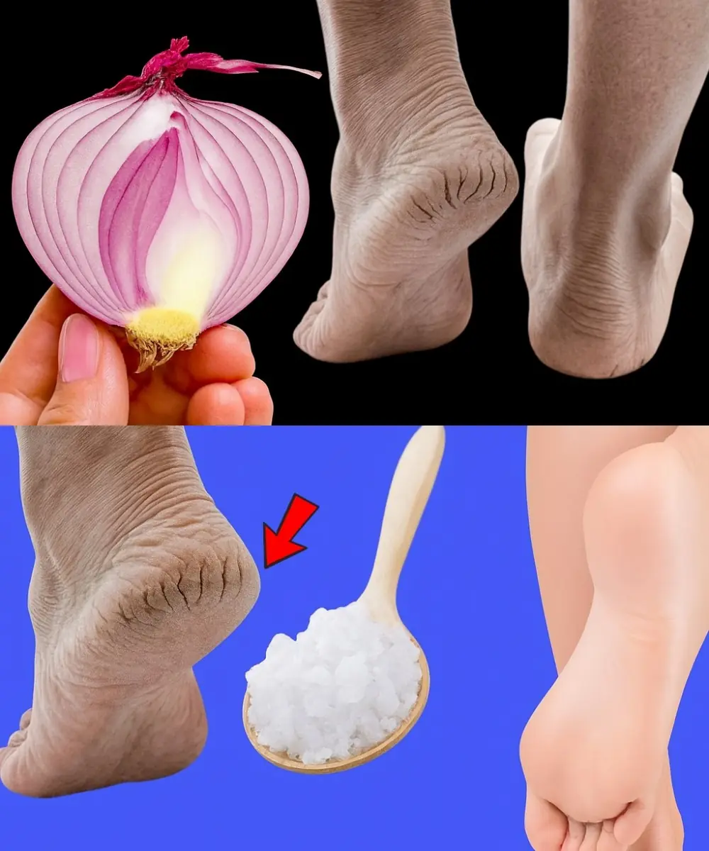 Cracked Heels? Unlock 5 Astonishing Natural Remedies That Truly Work!