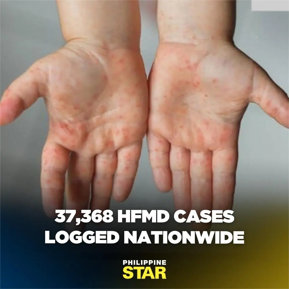 37,368 HFMD cases logged nationwide