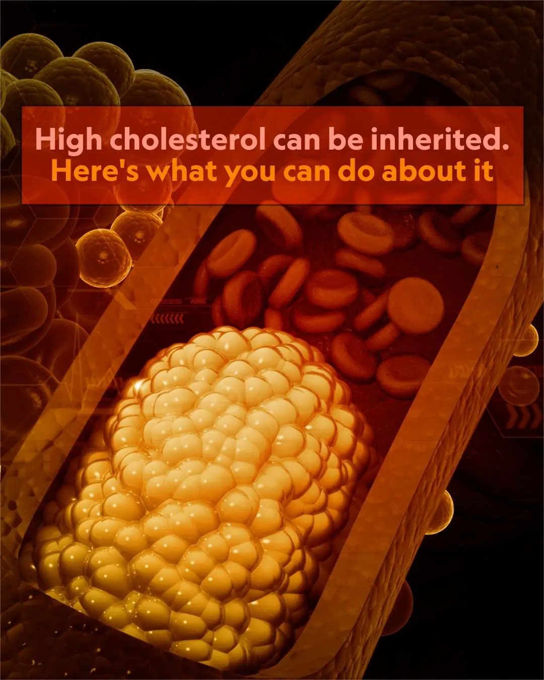 High cholesterol can be inherited. Here's what you can do about it