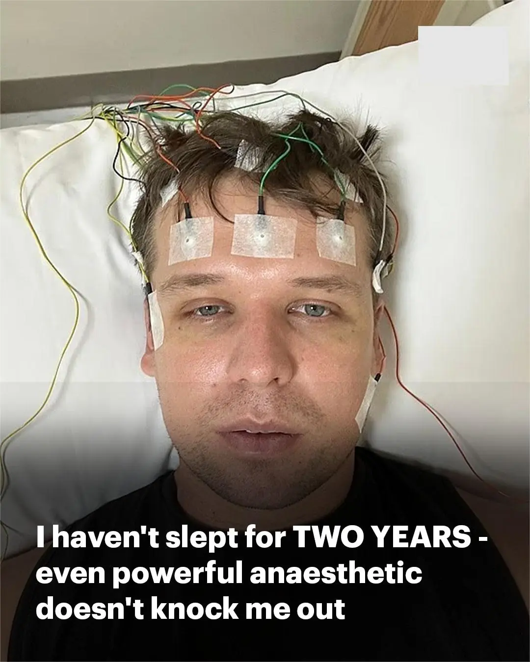 British Man Claims He Hasn’t Slept in Nearly Two Years, Even Under Powerful Anaesthetic