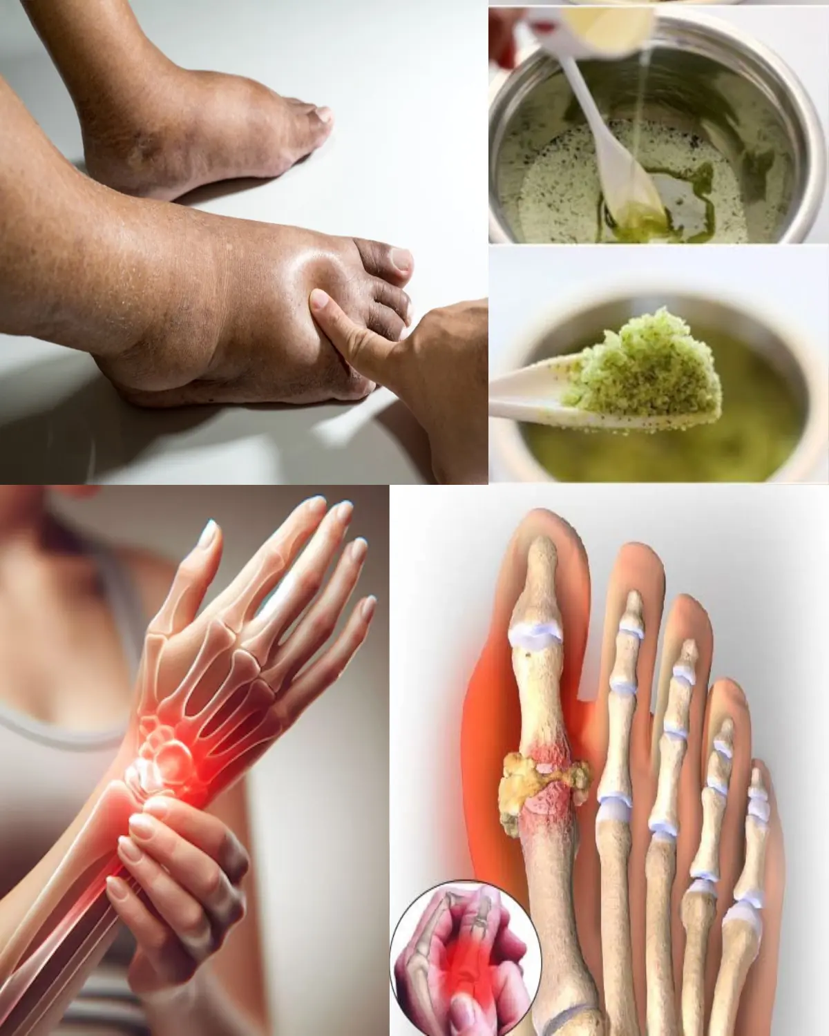 7 Teas That Stop Swollen Legs, Ankles, and Feet for Good