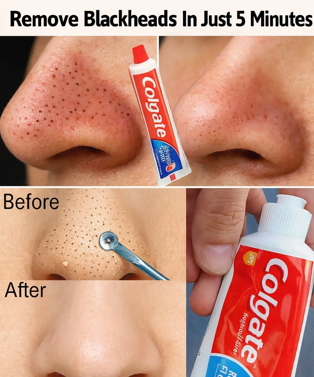 The Surprising Blackhead Hack You’ll Wish You Knew Sooner: Toothpaste in Just 5 Minutes!