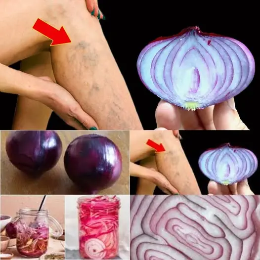 Discover the Magic of Red Onions for Varicose Veins