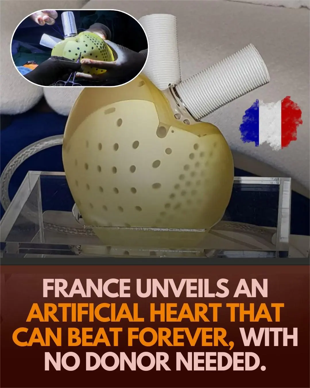 France’s Carmat Artificial Heart: A Game-Changer in Transplant Medicine