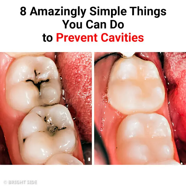 8 Surprisingly Easy Ways to Prevent Cavities