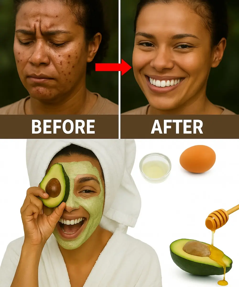 Zap Blackheads for Good: The Egg and Avocado Mask That’ll Transform Your Skin