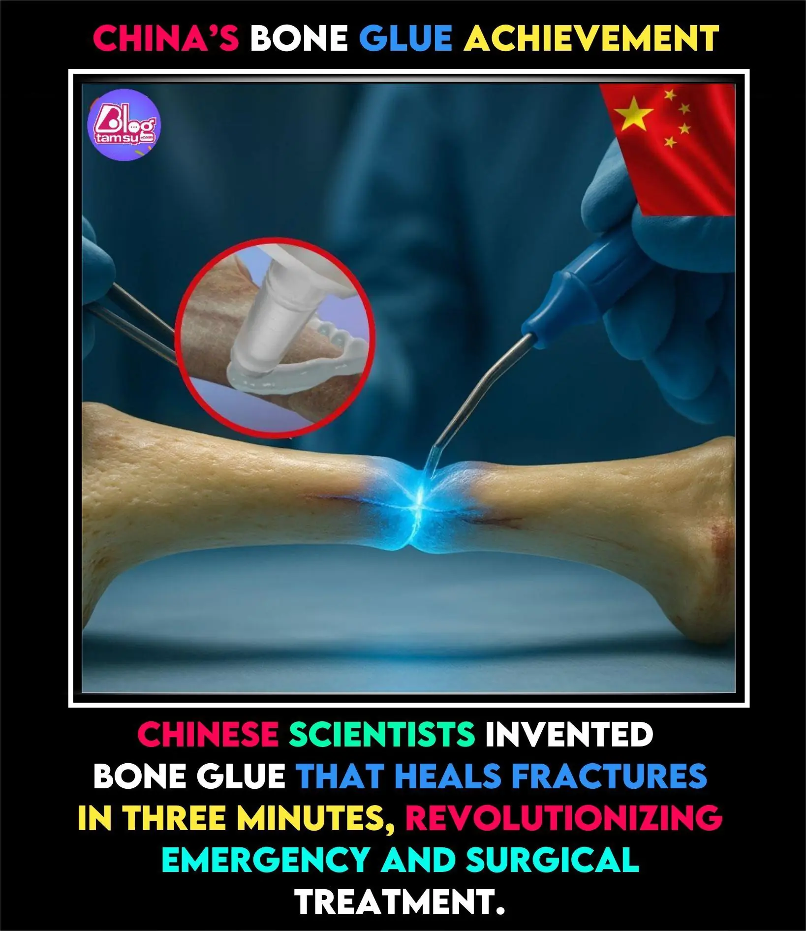 China’s Bone Glue “Bone-02” Promises Rapid Fracture Repair in Minutes: A Game-Changer in Orthopedics