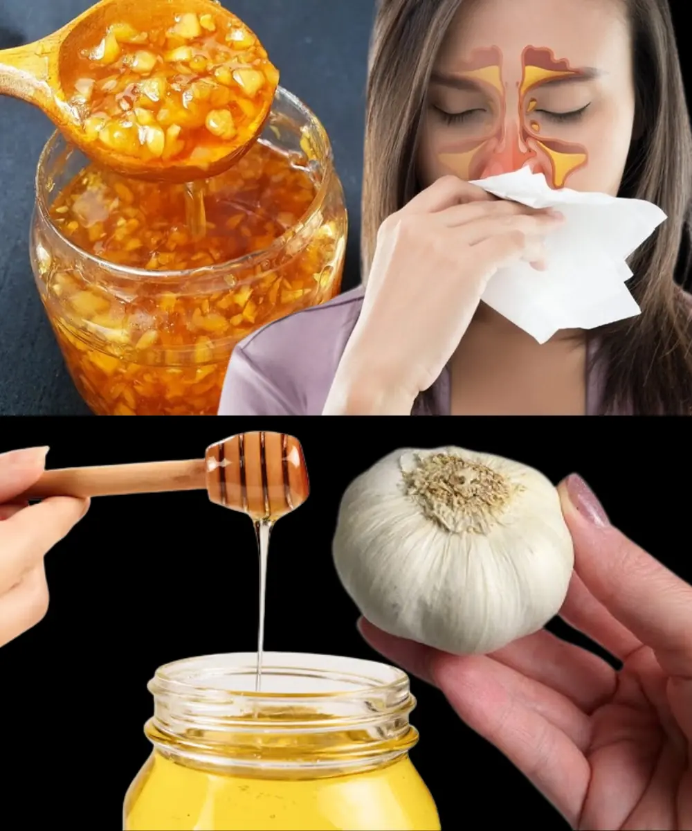 Garlic and Honey Remedy for Chronic Sinusitis: Detox Your Respiratory System and Boost Immunity