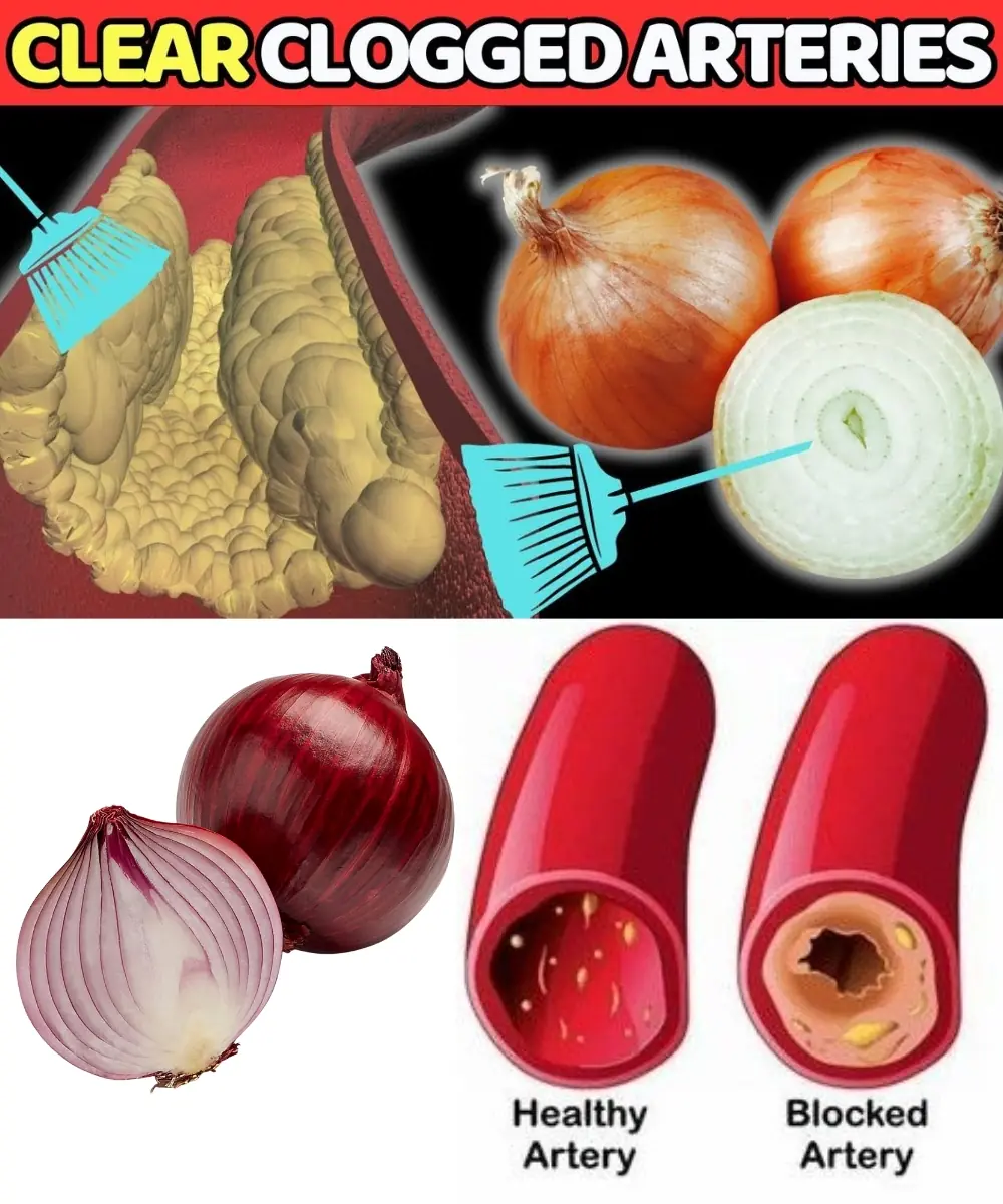 Onion Remedy That Naturally Unclogs Arteries and Boosts Heart Health ❤️🧅