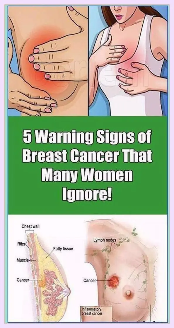 5 Warning Signs of Breast Cancer That Many Women Ignore