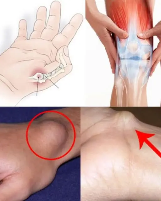 A Cyst on the Foot or Wrist: What You Should Know