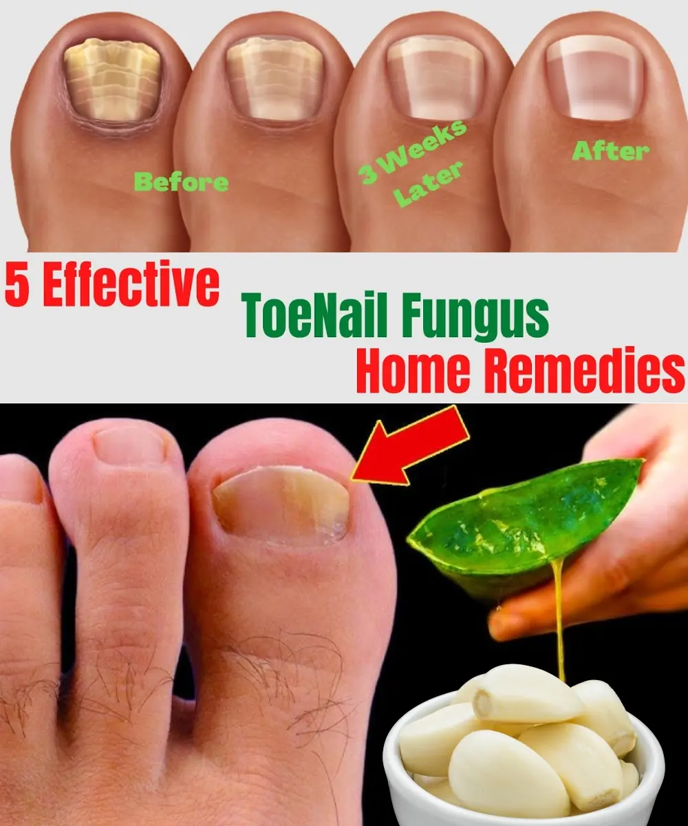 5 Natural Remedies for Toenail Fungus That Actually Work (Home Treatments That Are Backed by Nature)