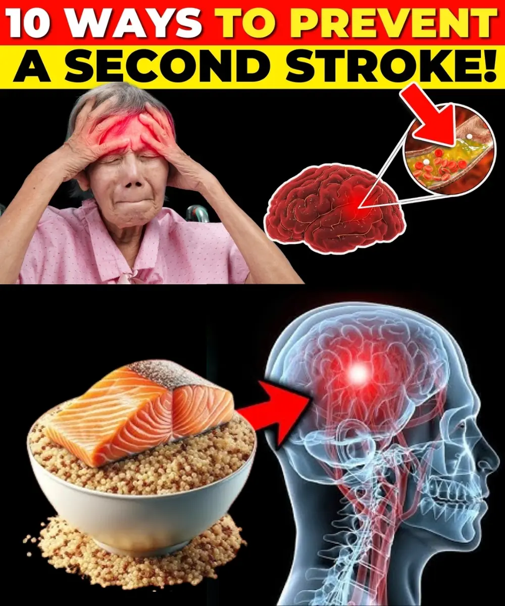 How to Reduce Your Risk of a Second Stroke (10 Things You Can Do)