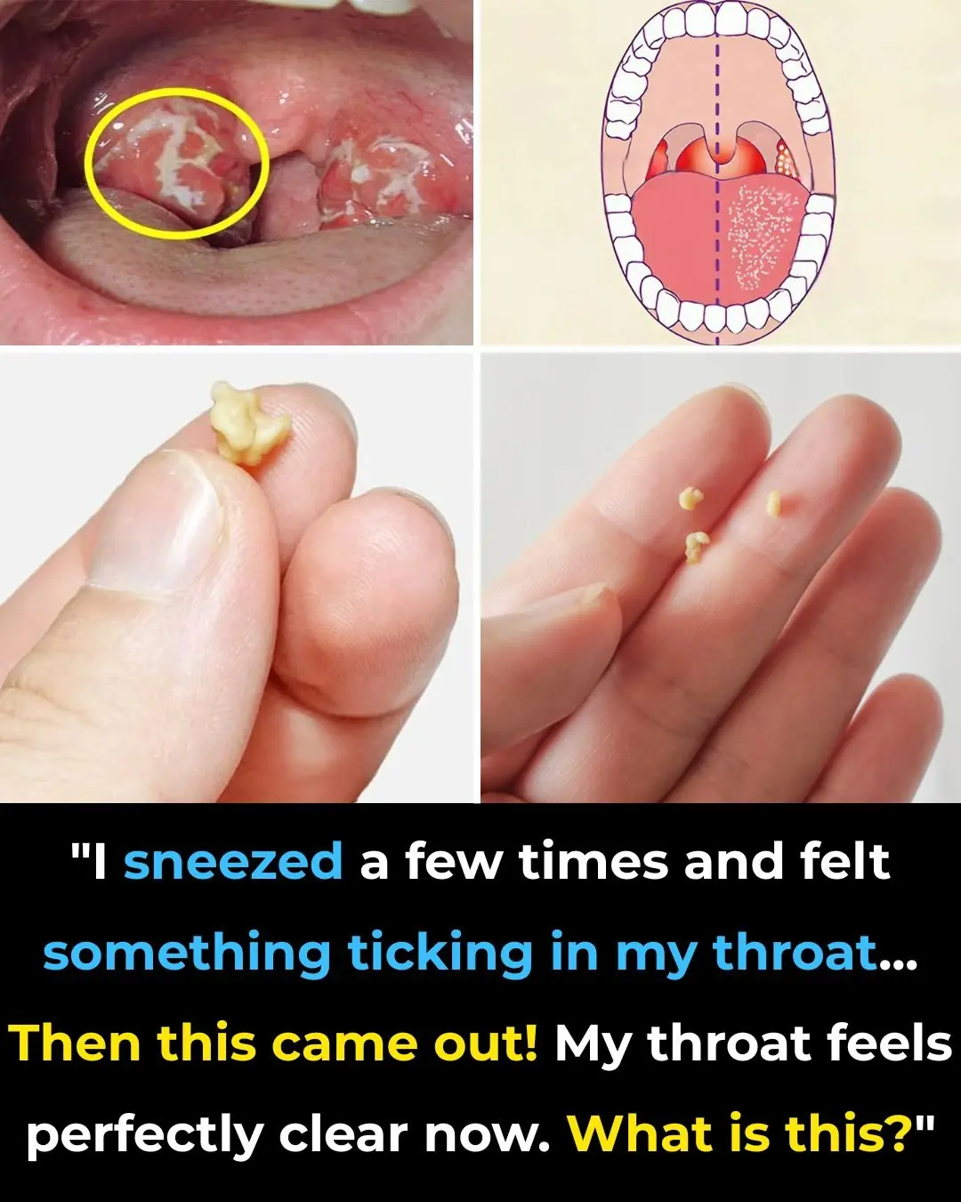 Here’s What You Need to Know About Tonsil Stones — Causes, Symptoms & Safe Removal
