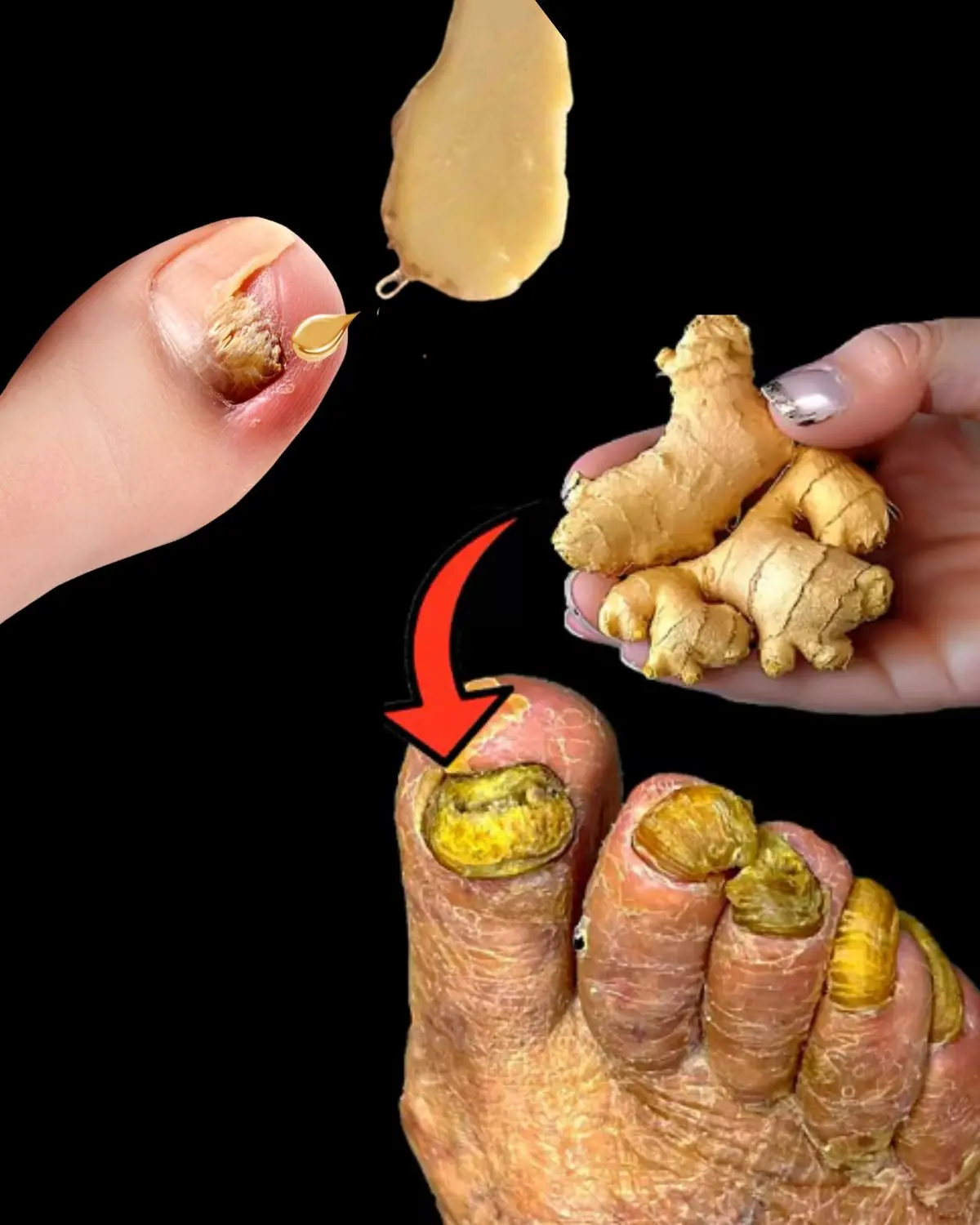 Discover Ginger’s Hidden Power for Thick Yellow Toenails