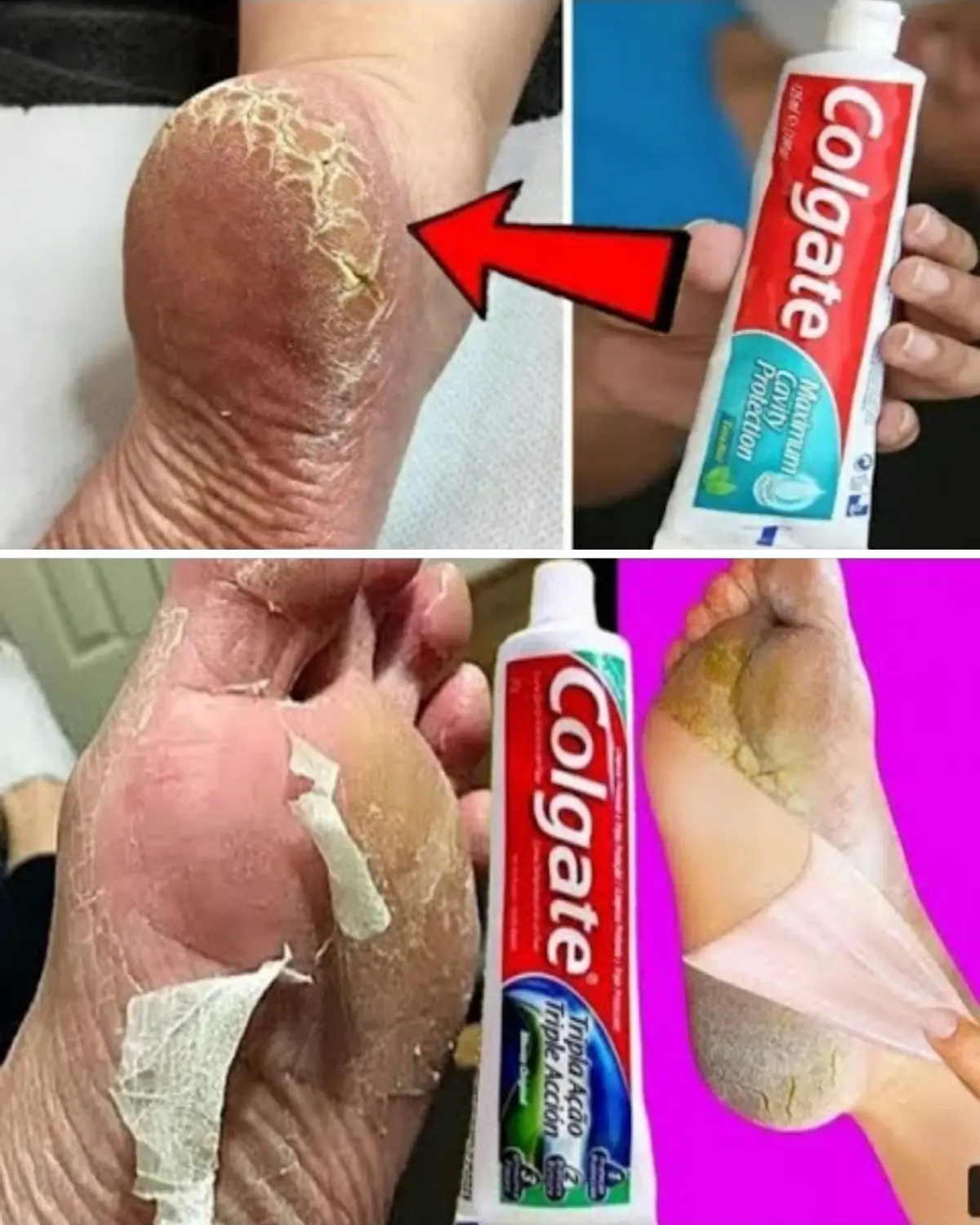 Unveil Colgate’s Surprising Secret for Softer Feet