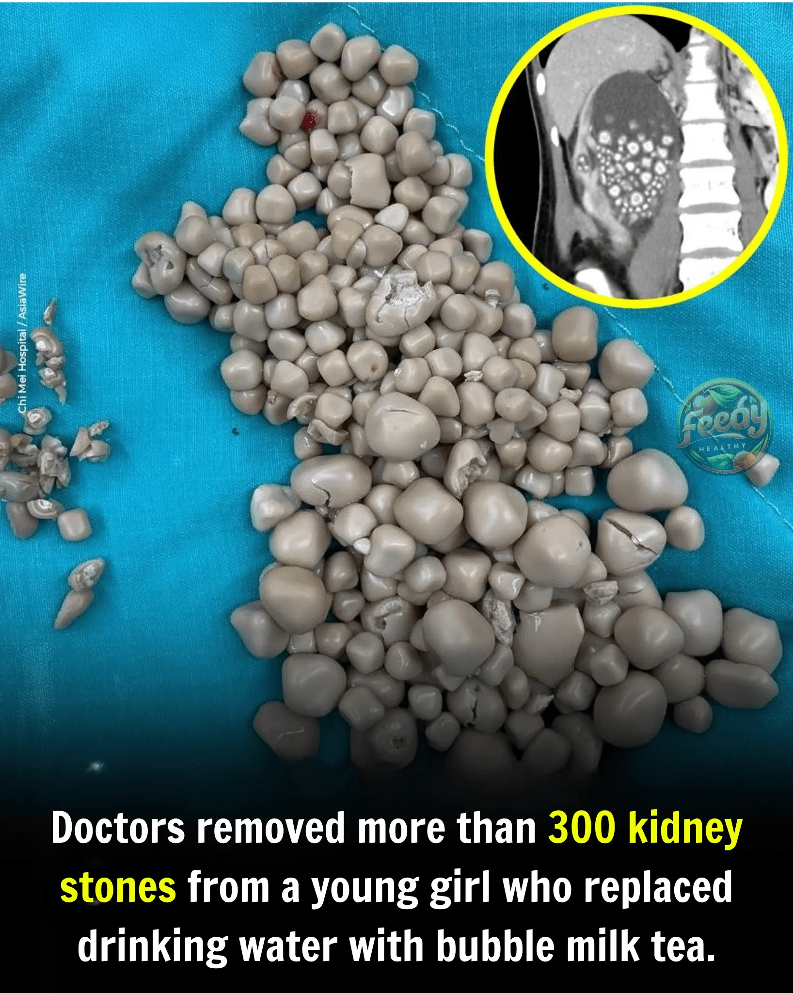 300 Kidney Stones Likely Caused by Drinking Bubble Milk Tea Instead of Water
