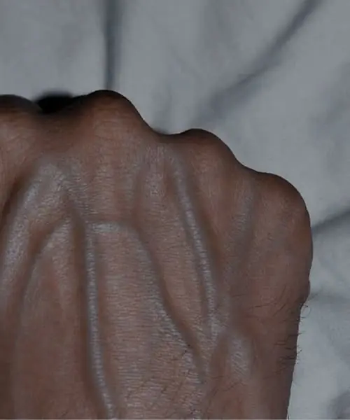 5 Health Conditions That Can Cause Visible Veins — And When to Worry