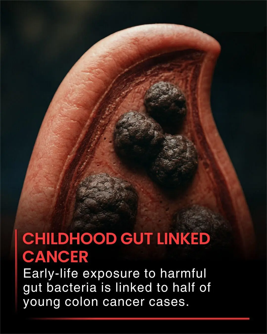 Scientists Trace Rising Early-Onset Colon Cancer to DNA-Damaging Bacterial Toxin