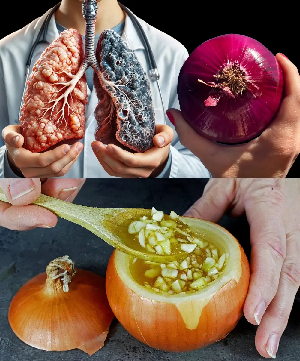 The Onion Antibiotic: A Powerful Natural Remedy for Cough, Bronchitis, and Pneumonia