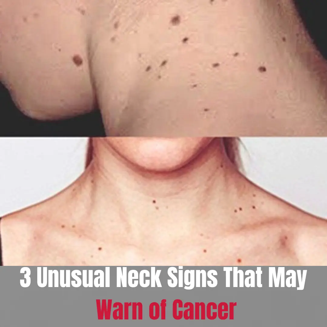3 Unusual Neck Signs That May Warn of Cancer