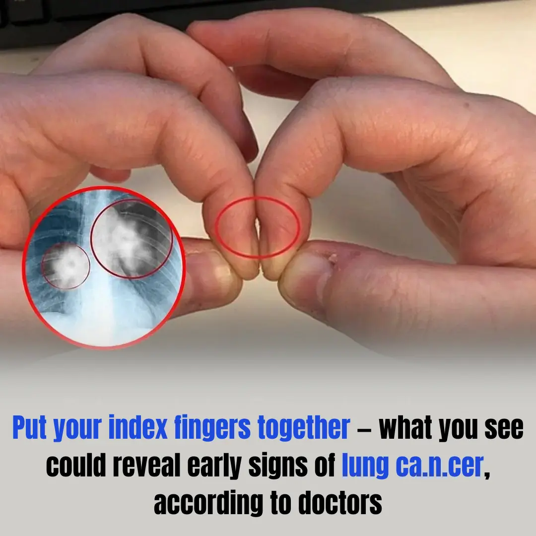 Put your index fingers together — what you see could reveal early signs of lung ca.n.cer, according to doctors