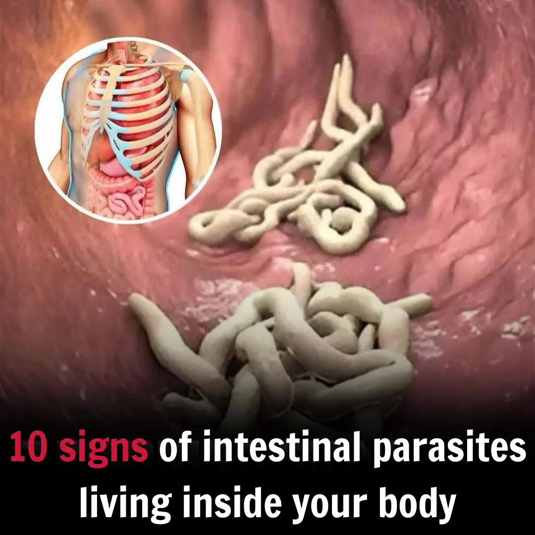10 Signs You Might Have Parasites