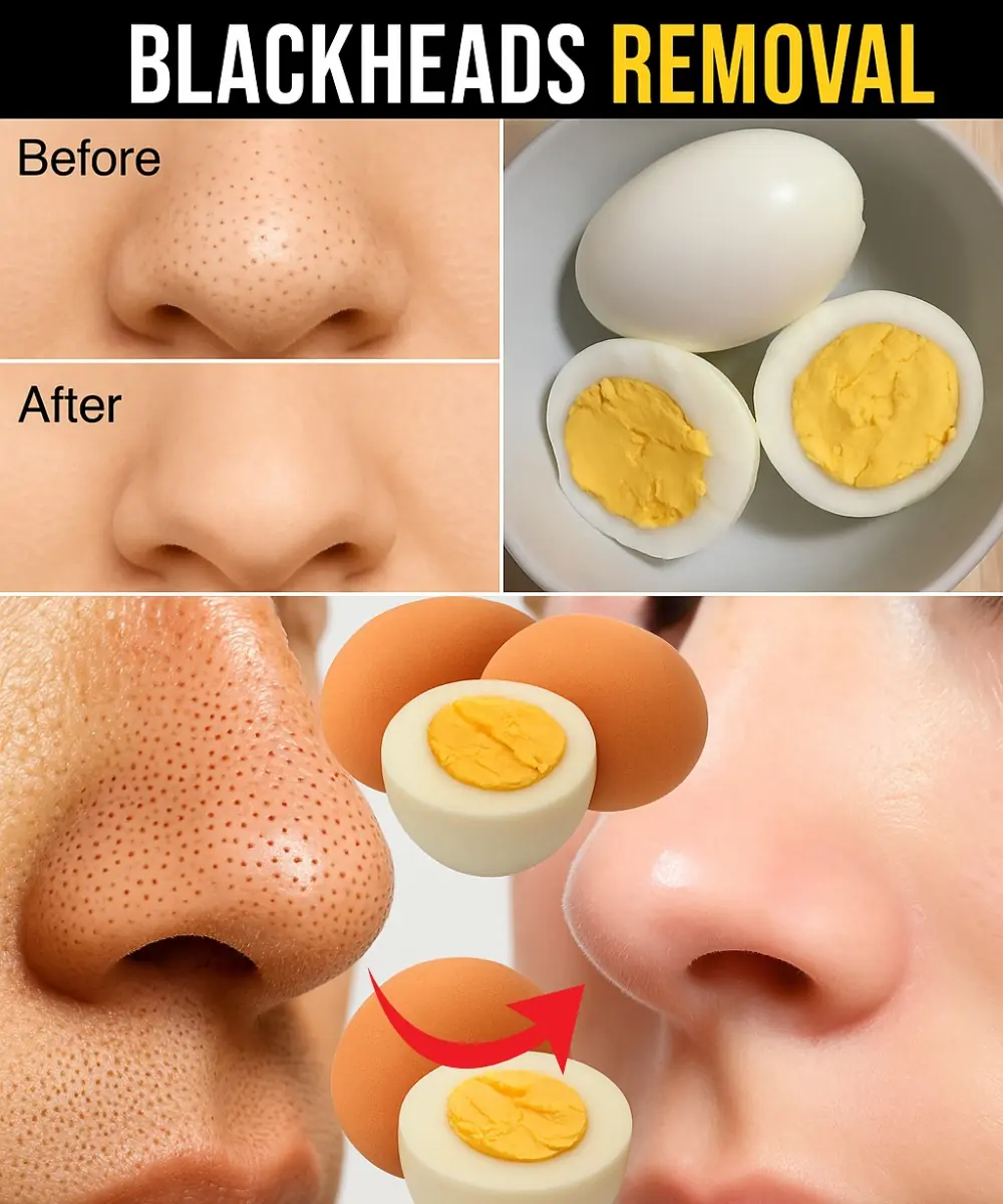 Banish Blackheads with One Egg – The Ultimate Natural Secret Revealed!