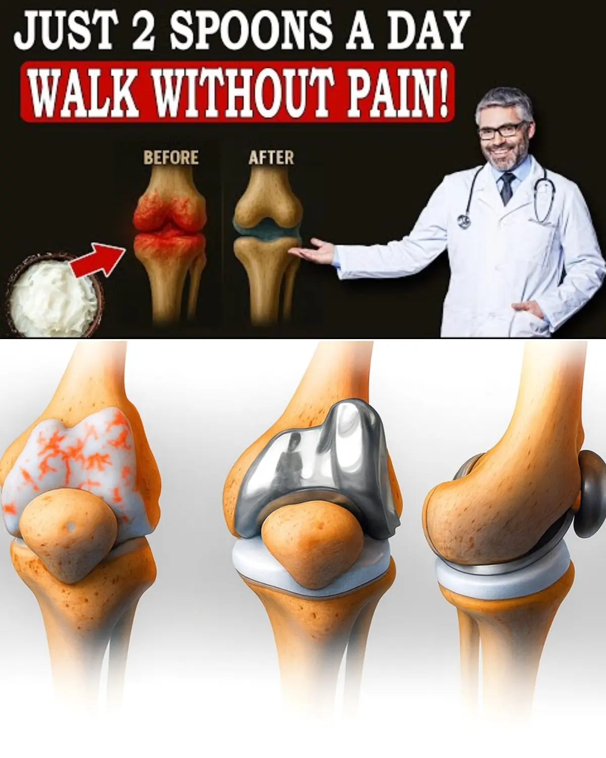 Debunking the Hype: Can One Food Really Rebuild Knee Cartilage Overnight?